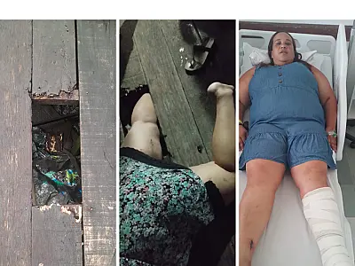 Mulher se acidenta nas palafitas de Santos e espera por cirurgia