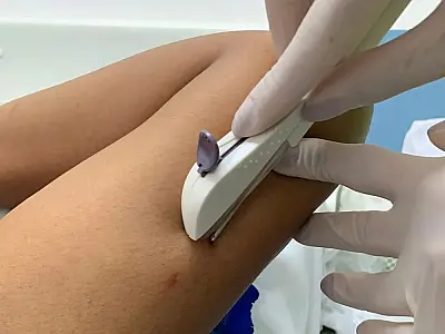 SV abre 200 vagas para colocação de contraceptivo em adolescentes de 15 a 17 anos