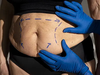 Diástase abdominal: o que é, sintomas, prevenção e tratamento