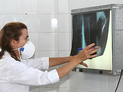 Tuberculose: medicamento para tratamento mais curto está sob consulta