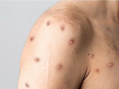 Saúde se mobiliza após 709 casos e 16 óbitos por mpox no Brasil em 2024