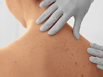 Especialista alerta sobre os cuidados essenciais para evitar o câncer de pele