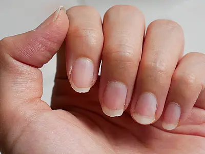 Unhas fracas e quebradiças: o que ocasiona e como cuidar?