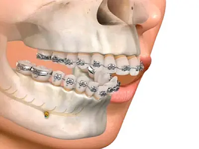 Praia Grande amplia a oferta de cirurgia bucomaxilofacial na rede municipal