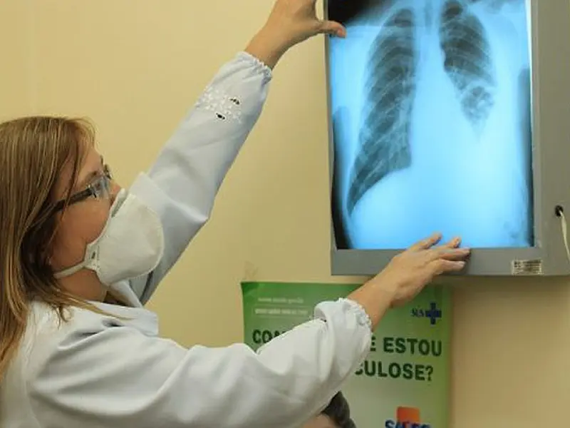 Brasil instala comitê interministerial para eliminação da tuberculose
