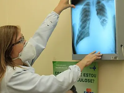 Governo cria comitê para eliminar a tuberculose