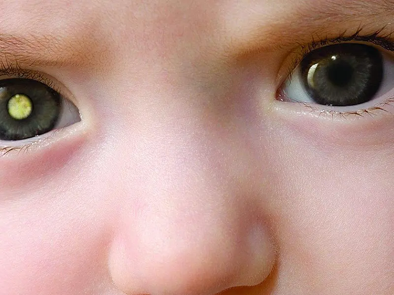 Tumor ocular mais comum em crianças pode causar cegueira