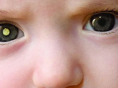 Tumor ocular mais comum em crianças pode causar cegueira