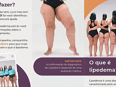 No mês de conscientização do Lipedema, ONG apresenta nova campanha e realiza ações em seis captais
