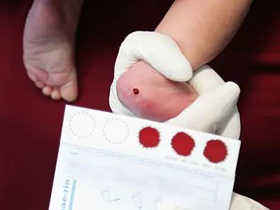 Ampliação do teste do pezinho permite detecção precoce de doenças raras