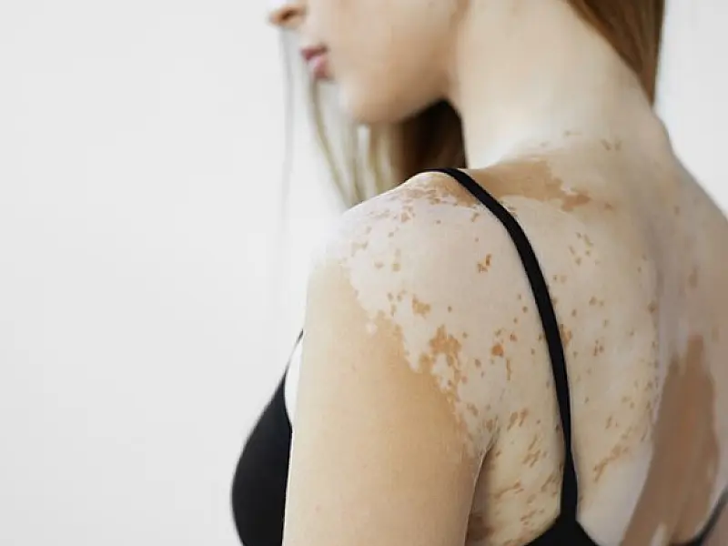 Pele com vitiligo exige cuidados especiais e hidratação reforçada