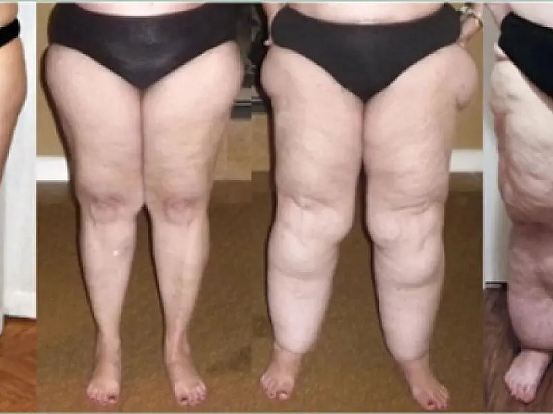 Alimentação e terapias combinadas são fortes aliados no combate do Lipedema