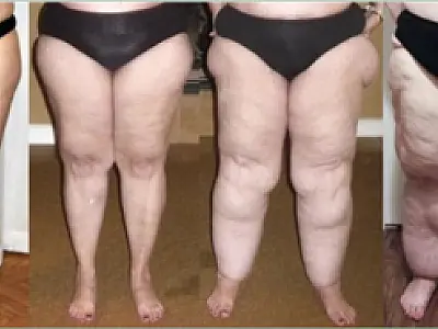 Alimentação e terapias combinadas são fortes aliados no combate do Lipedema