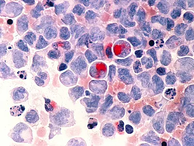 Terapia celular inovadora leva à remissão de leucemia