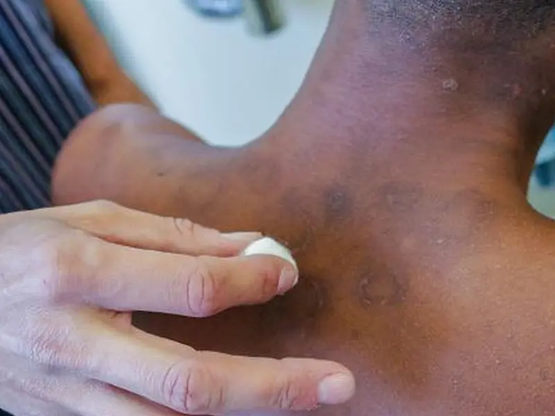 Janeiro Roxo alerta para a conscientização sobre a hanseníase