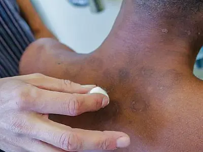 Janeiro Roxo alerta para a conscientização sobre a hanseníase