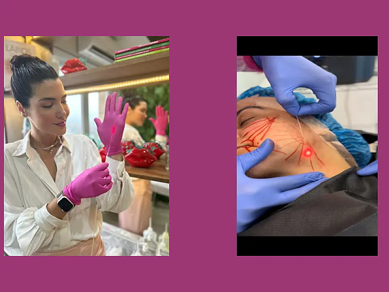 Endolifting: a técnica revolucionária para rejuvenescimento facial não invasivo