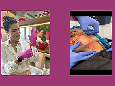 Endolifting: a técnica revolucionária para rejuvenescimento facial não invasivo