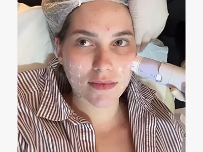 Virgínia Fonseca - Confira as tecnologias adotadas no tratamento dermatológico da influenciadora