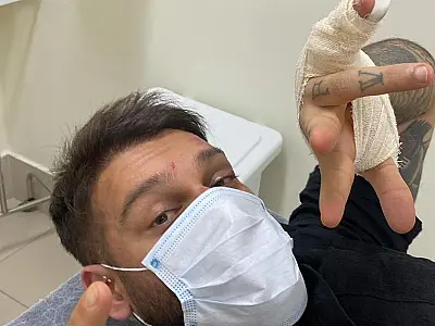 Lucas Lucco preocupa fãs após aparecer com o rosto machucado