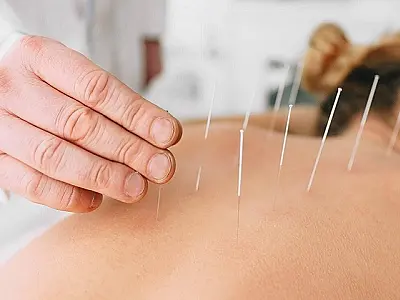 Acupuntura: saiba os benefícios e contraindicações da terapia