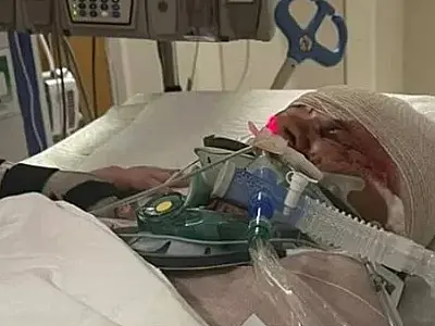 Mulher tem dois braços amputados após ataque de pitbulls