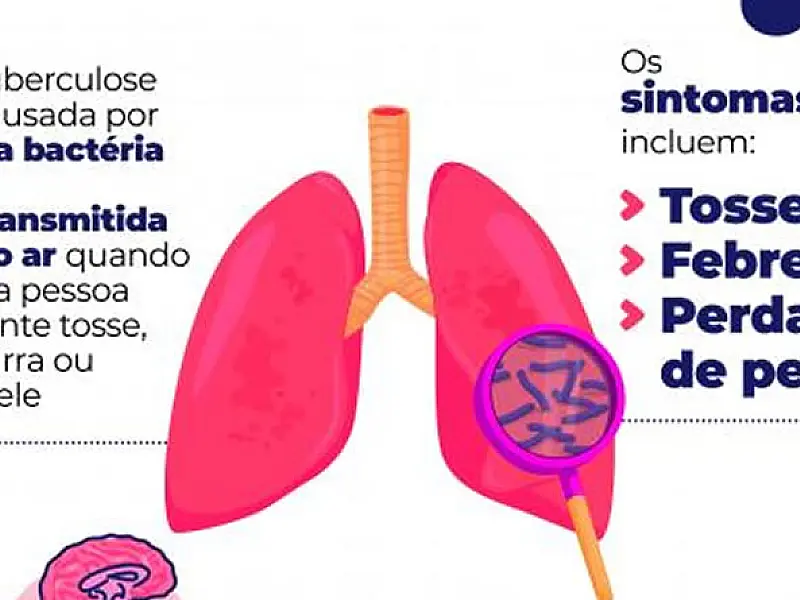Campanha contra a tuberculose será permanente em Santos