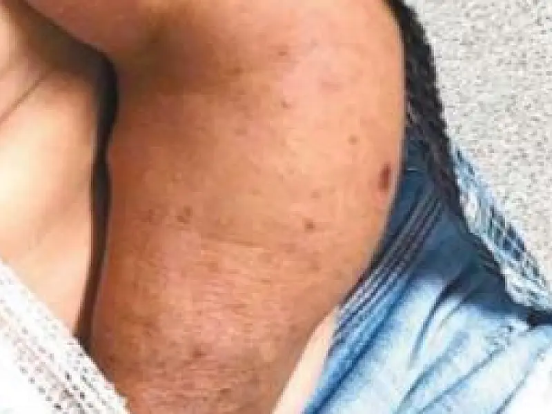 Idoso que teve o braço quebrado ficará sem trabalhar por quase três meses