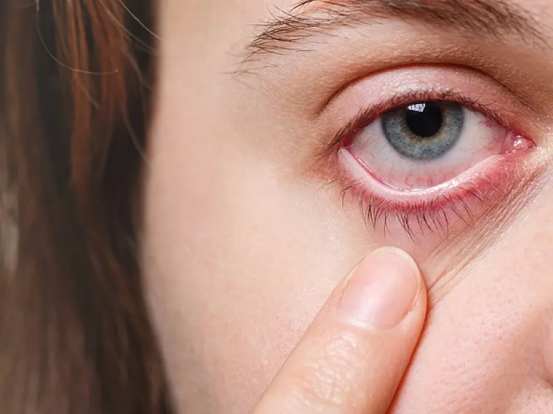 Alergia ocular: descubra como proteger seus olhos e evitar o incômodo