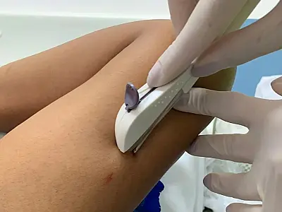 'Mutirão do Contraceptivo Implanon' contempla mais de 100 adolescentes