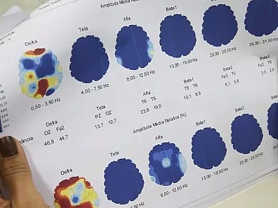 Março Roxo quer conscientizar população sobre a epilepsia
