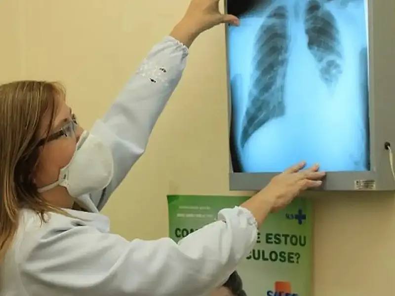 Baixo financiamento mundial ameaça combate à tuberculose