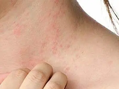 Infectologista pediátrica tira dúvidas sobre a sarna humana, diagnosticada em 12 crianças