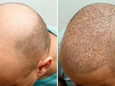 A Influência das Redes Sociais na Busca pelo Transplante Capilar: Quando a Estética Encontra a Expos