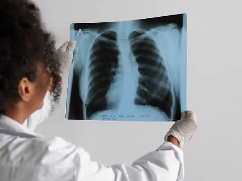 São Vicente amplia atendimento e oferece tratamento contra tuberculose em todas as unidades de saúde