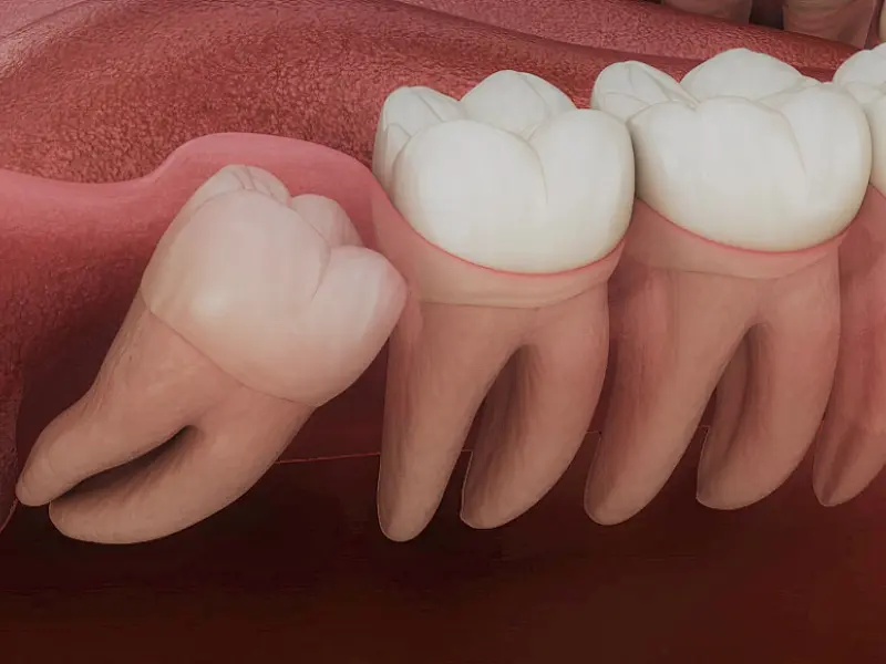 Dente do Siso: Quando retirar? E o pós-extração? Dentista esclarece dúvidas