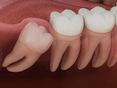 Dente do Siso: Quando retirar? E o pós-extração? Dentista esclarece dúvidas
