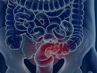 Estudo projeta aumento de 36% em mortes por câncer colorretal até 2040
