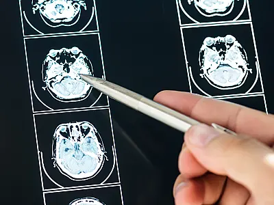 Doença de Alzheimer e Demência; entenda suas diferenças e seus quadros