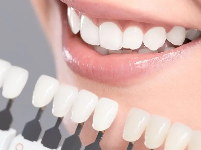 Conheça os riscos e benefícios das lentes de contato dental